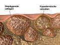 Celulitis