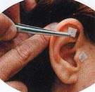 Puntos de auriculoterapia para adelgazar